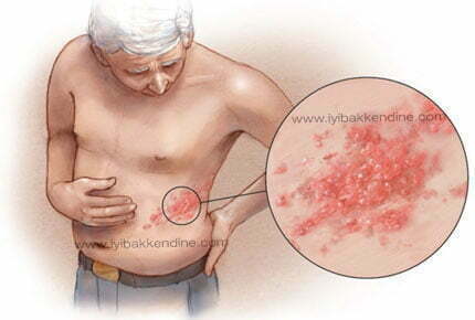 zona hastalığı shingles