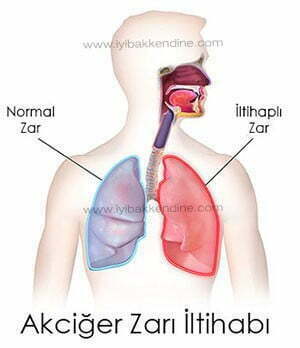 akciğer zarı iltihabı