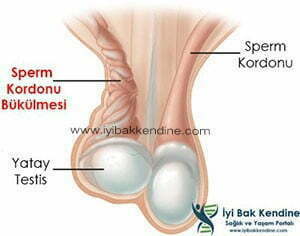 Testis Bükülmesi Torsiyonu