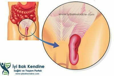 kasık fıtığı