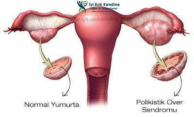 polikistik over sendromu yumurtalık kisti