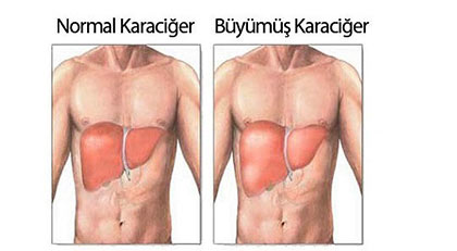 karaciger-buyumesi